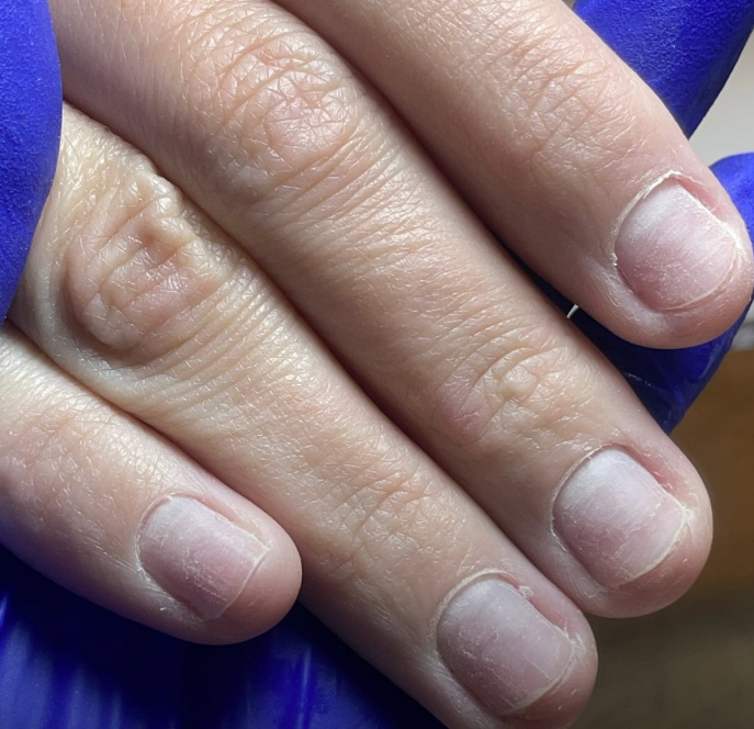 Antes - Unhas roídas